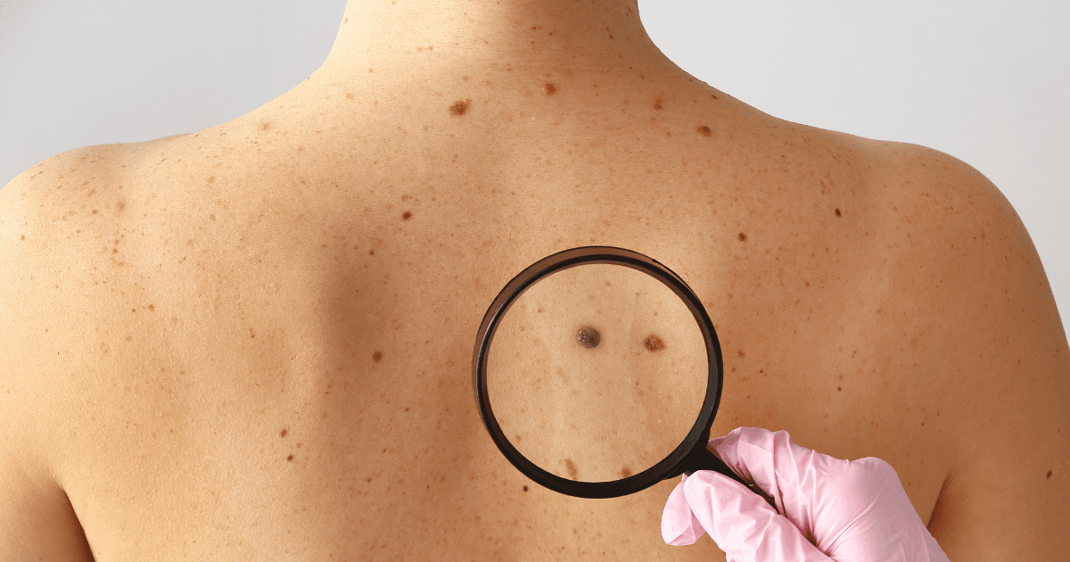 Un professionnel de santé examine à la loupe des grains de beauté sur le dos d'une personne.